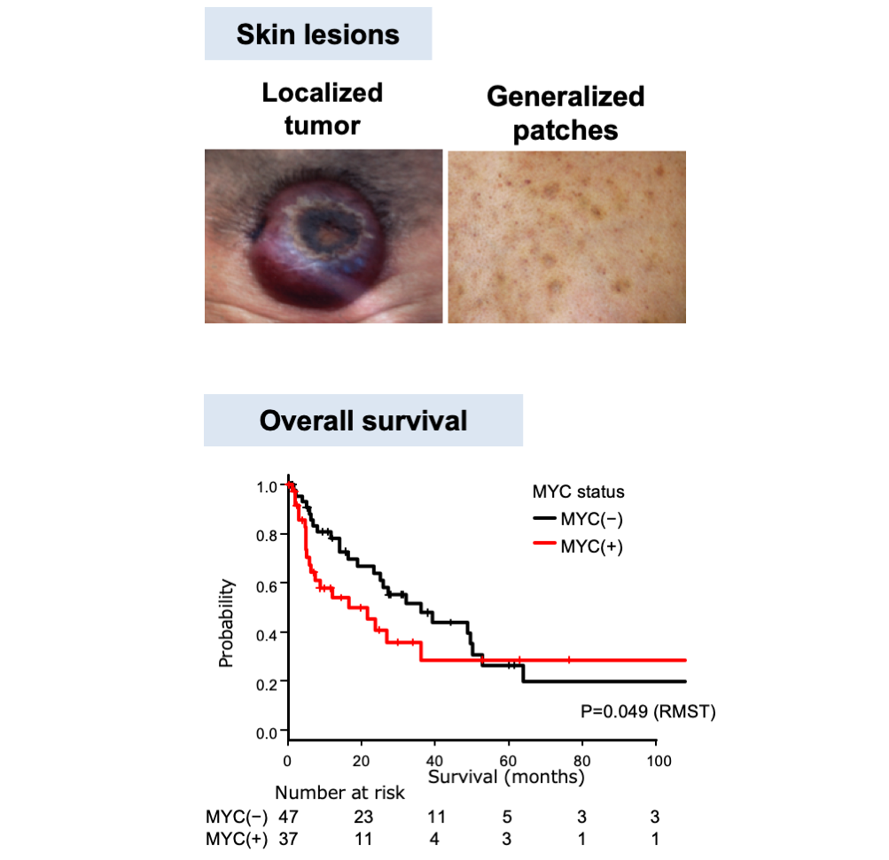 Figure 2. Clinical characteristics of MYC+BPDCN and MYC-BPDCN