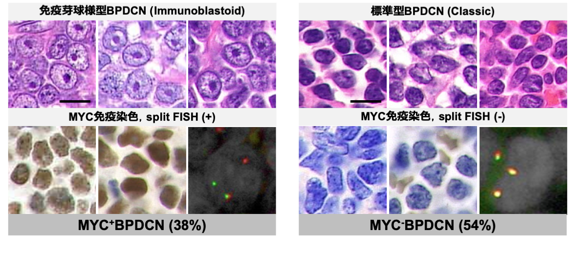 細胞形態とMYC異常の関連