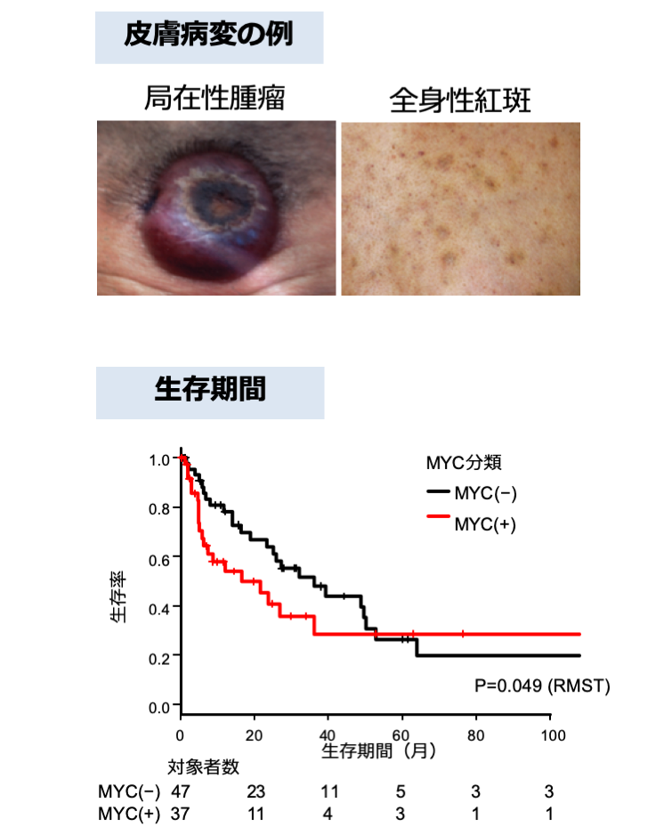 MYC<sup>+</sup>BPDCNとMYC<sup>-</sup>BPDCNの臨床病理学的相違